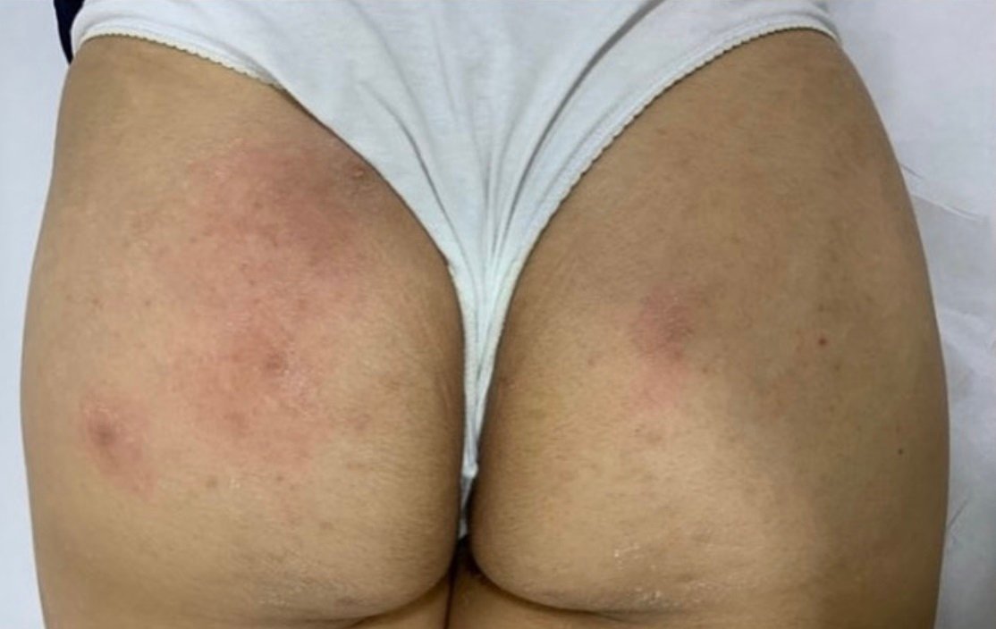 Foto de resultado após a rotina — caso 3
